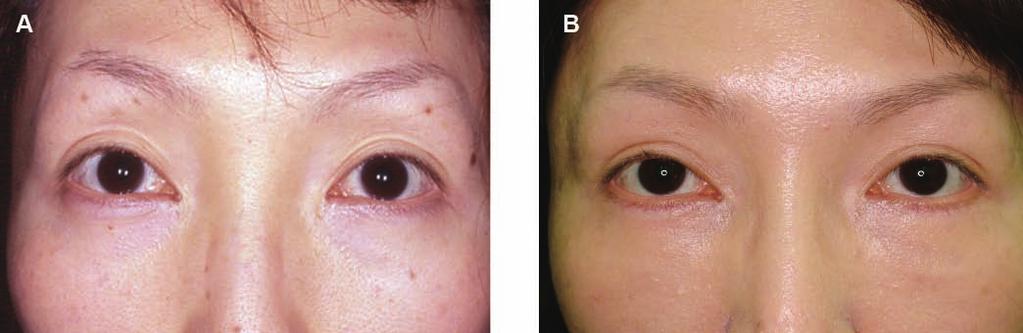 the subeyebrow line. (C) Four months after skin-muscle excision, the patient s result was natural without any complications. Figure 8.