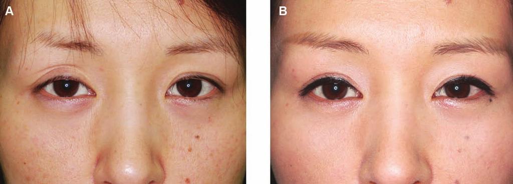 176 Aesthetic Surgery Journal 31(2) Figure 9. (A) This 31-year-old woman presented with unilateral sunken eye deformity and a shallow crease on her right upper eyelid.