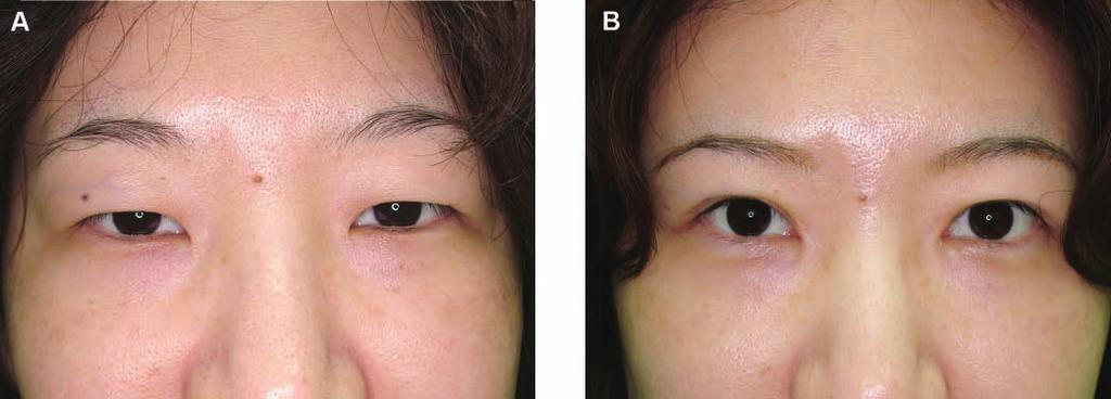 (A) This 40-year-old woman presented with a single Asian eyelid appearance. She desired a more youthful upper lid. (B) Five months after treatment with a double eyelid incision technique.