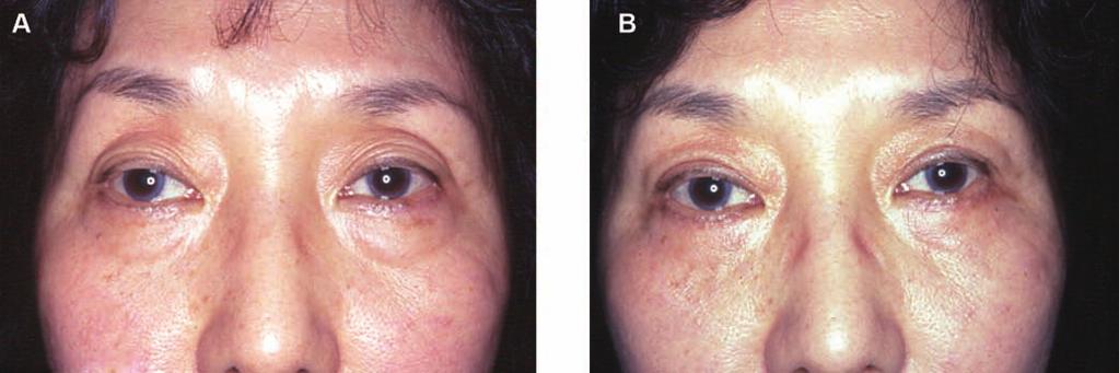 Takayanagi 177 Figure 11. (A) This 63-year-old woman presented with dermatochalasis with excess rhytids. She requested removal of her wrinkles and the concave deformity of the upper eyelid.