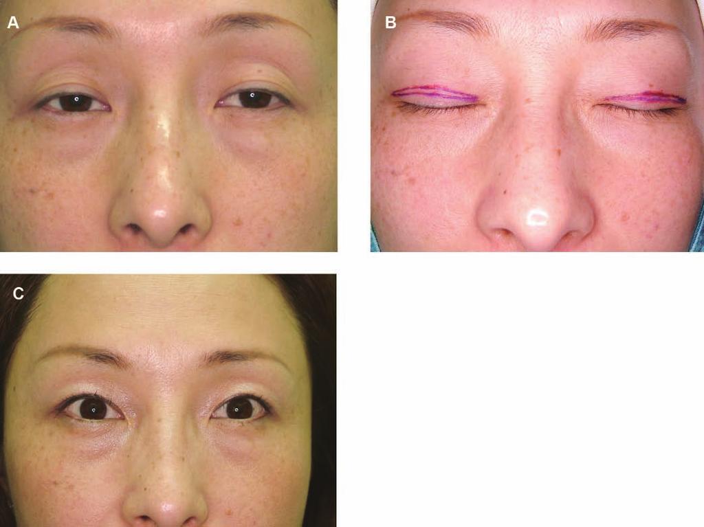 178 Aesthetic Surgery Journal 31(2) Figure 13. A, This 53-year-old woman presented with a sunken eyelid deformity and ptosis.