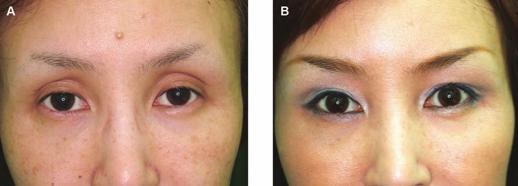 Takayanagi 179 Figure 14. (A) This 52-year-old woman presented with a sunken eyelid deformity and ptosis.