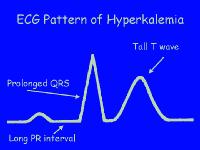 Hyperkalemia Tall peaked T waves RAD (Left posterior fascicular block?
