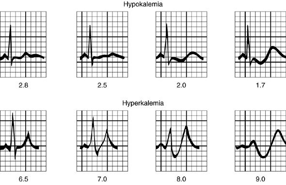 Broadening of the QRS Peaked T waves