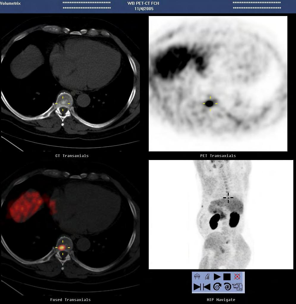 Recurrent bone metastasis after prostatectomy and