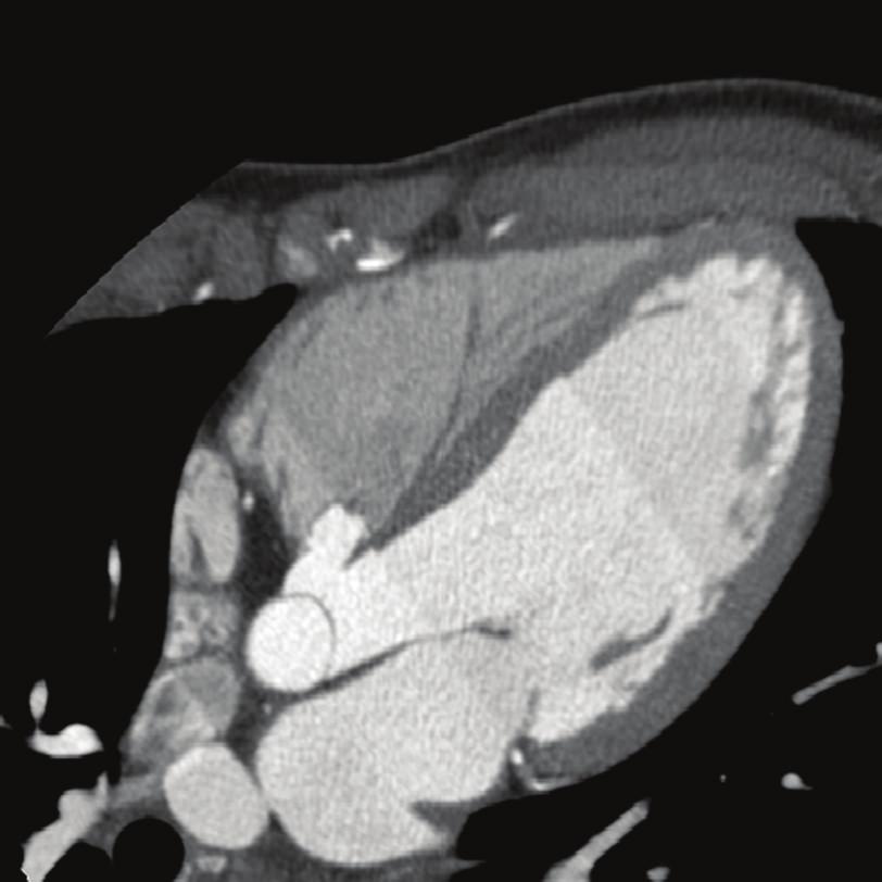 2 Case Reports in Cardiology (a) (b) (c) Figure 1: CT imaging results of the female track and field athlete. (a) Four-chamber view depicting an aneurysm of the membranous ventricular septum.