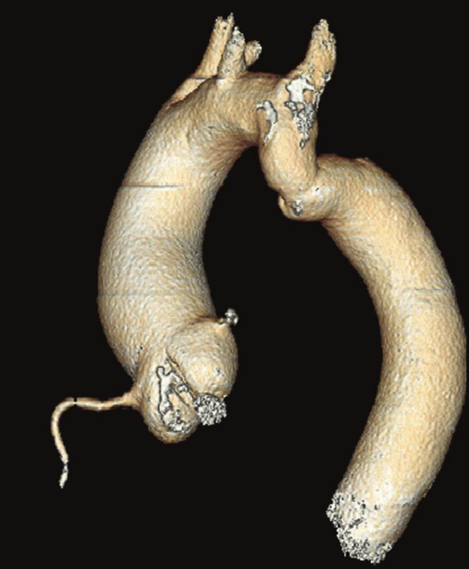 Case Reports in Cardiology 3 Figure 2: Three-dimensional volume-rendered image of the aorta in the elderly patient demonstrating mild aortic coarctation distal to the left subclavian artery.