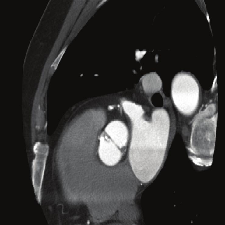 Additionally, our second case elucidates the possible association between a bicuspid valve and the manifestation of a VSA.