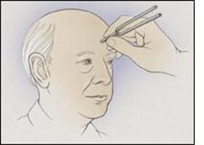 In an affected patient, if the defective ear hears the Weber tuning fork louder, the finding indicates a conductive hearing loss in the defective ear.