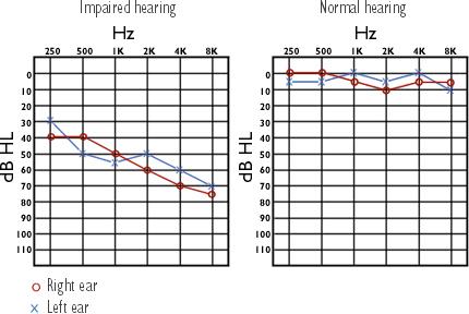Figure 52-12 Audiogram of the