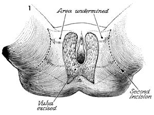 Labiaplasty Majora (wide local excision of vulva with skin graft) multicentre
