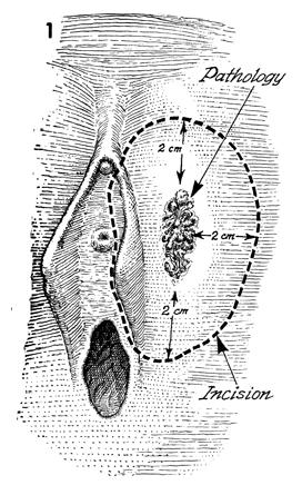 Labiaplasty Majora (wide