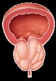 The partial interruption of prostate arterial blood supply causes the abnormal enlarged tissue to atrophy, shrinking in size.