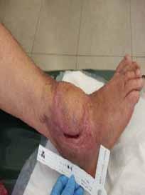 clinical signs of infection were noted. This was very significant in Patient KEK001 with a history of chronic Pseudomona infections.