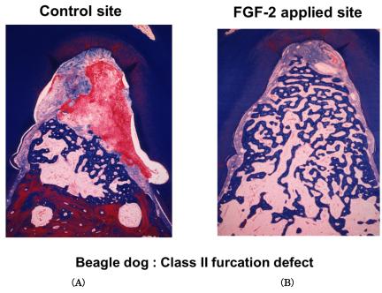 2 FGF-2-promoted angiogenesis at the defect sites of periodontal tissue Topical application of 0.3% FGF-2 to artificially created threewalled bony defects in dogs promoted newly formed blood vessels.