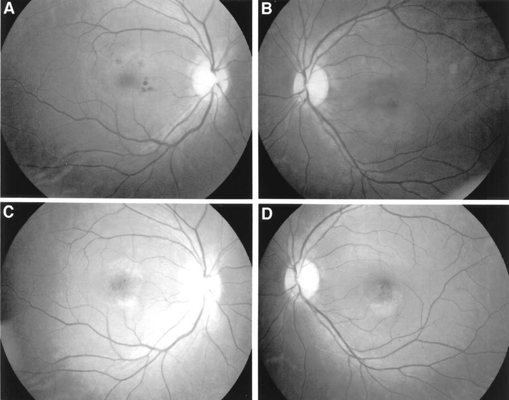 386 Jpn J Ophthalmol Vol 47: 385 391, 2003 ophthalmoscopy (SLO), optical coherence tomography (OCT), and multifocal electroretinography (mferg) from its early stage to its resolution.