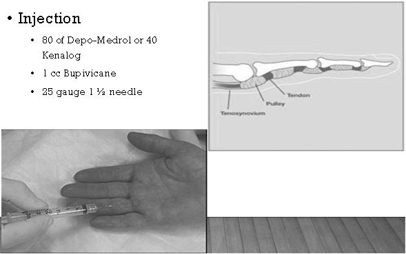 Injection TRIGGER FINGER - A1 PULLEY STENOSIS 80 of Depo-Medrol or 40 Kenalog 1 cc Bupivicane 25