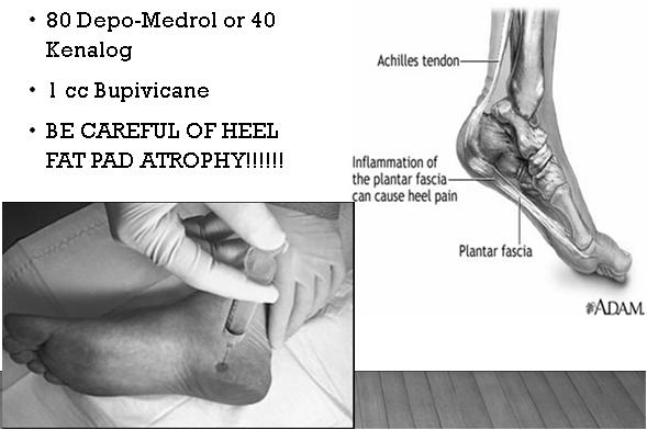 are not injecting the tendon Some acute triggering will stop on its own with rest, NSAIDS, and ice