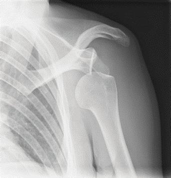 4 Reduces shoulder pain Prevents further injury Provides immobilisation Provides support to shoulder