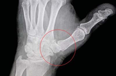 management of injuries awaiting orthopedic intervention Osteoarthritis & degenerative joint disease