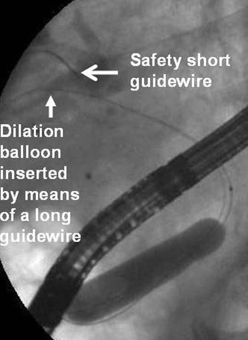This means that guidewires slide within the instruments a very short distance, and are largely parallel (Fig. 1).