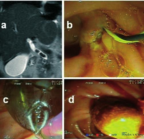Fig. 4. The whole procedure of biliary sphincterotomy dilation to extract difficult common bile duct stones. a. Magnetic resonance cholangiography showing two middle-sized common bile duct stones. b. The papilla of Vater is positioned at the bottom of a diverticulum.