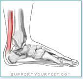 Achilles Tendinitis Solutions If caused by overpronation, consider a stability or motion control