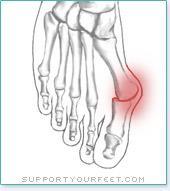 Hallux Valgus - Bunions Solutions If caused by overpronation, stability or motion control shoe/insert.