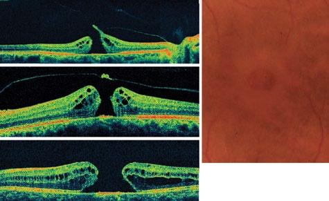 Optical coherence tomography makes classifying the status of the vitreous and the size of FTMHs easier.