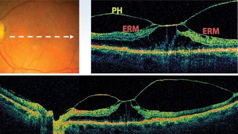 In some cases, retinal cysts are seen on OCT, which will most likely preclude surgery. In FTMH, it is important to consider the risk of MH in the patient s fellow eye.