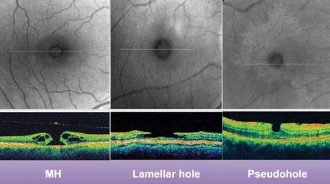*JETREA is indicated in adults for the treatment of vitreomacular traction, including when associated with macular hole of diameter less than or equal to 400 µm.