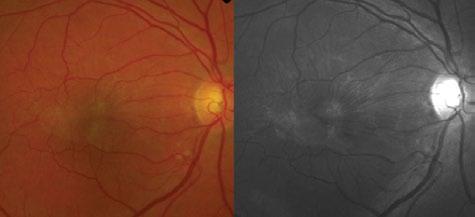 Red-free photographs and blue-reflectance photographs give more details than color fundus photographs. Figure 8.