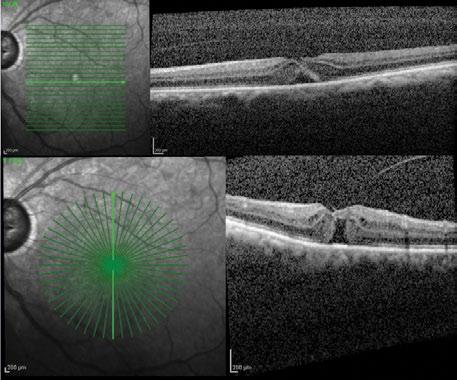 400 µm (Figure 1). Because she had visual loss in her good eye and a fairly small FTMH, I considered her a good candidate for ocriplasmin injection.