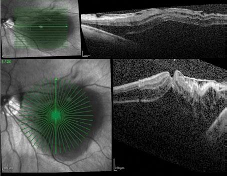 POOR PATIENT SELECTION A 57-year-old woman who is an attorney travels 2 to 3 times a week via airplane. She presented to me with 20/200 visual acuity that had persisted for 6 months.