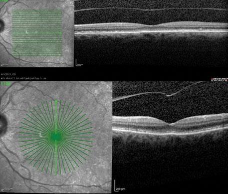 One month later, the patient experienced a complete PVD, and on OCT her retina was completely flat, with complete resolution of the VMT.