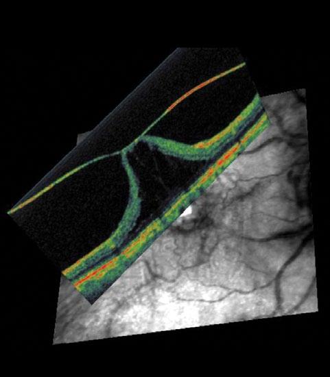 peripheral vitreous but persistent adhesion of full thickness posterior vitreous cortex to the macula, axial traction in an anterior-posterior direction can result, which plays an important role in