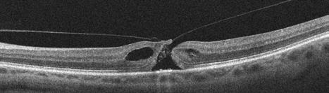 PGE 2 case profile cont... Macular holes ob presented with spectacles for reading and a low myopic astigmatic prescription for distance.
