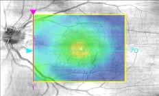 nterior segment examination showed clear corneas in both eyes and mild to moderate nuclear sclerosis (grade 2) of comparable density in both eyes.