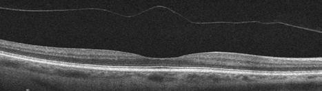 membrane and macular holes as possible causes.