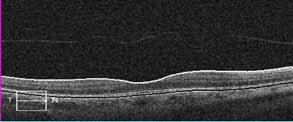 OCT ETDRS macular thickness grid for ob s right eye (C) and ob s left eye (D) shows a significantly thicker central subfield in the left eye.