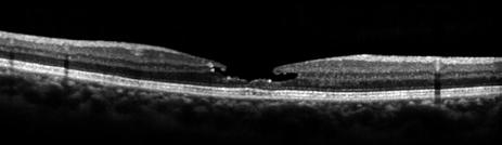 PGE 3 Figure 3: OCT line scan showing a Stage 1 macular hole. Figure 4: Full thickness macular hole (Stage 3) from the right eye () and left eye () of the same individual.