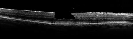 Pathology attributed to macular hole formation varies, from subtle anomalies of the macular vitreoretinal interface to partial thickness (lamellar) or full-thickness breaks in