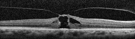 Full-thickness macular holes are thought to form largely from vitreomacular traction 3, with traction tangential to the retina being significant.