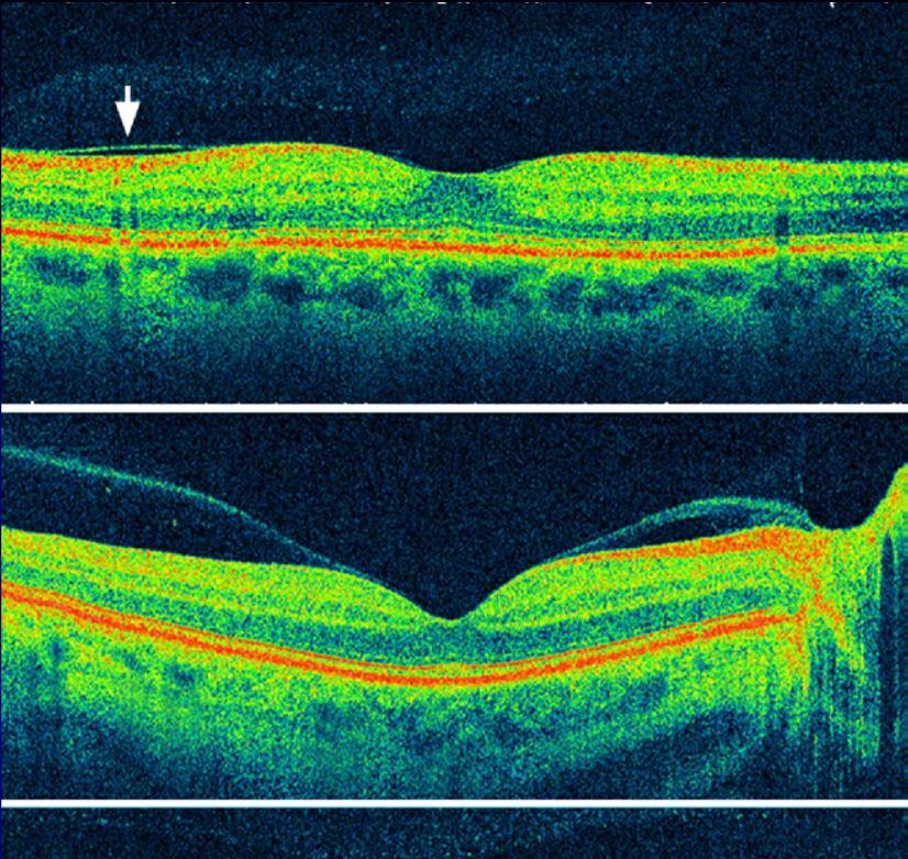 Spectral-domain optical coherence tomography images of early stages of posterior vitreous detachment (PVD) in asymptomatic