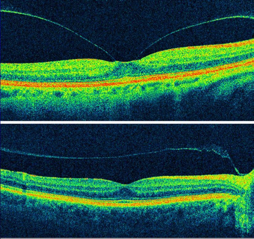 (Second row) Evolving perifoveal PVD with broad residual macular adhesion in a 54-year-old man.