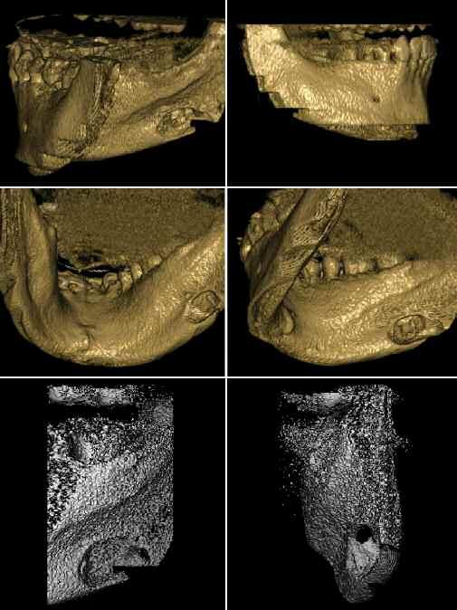 On 3-dimensional imaging views of the lingual aspect of the man-dible obtained with a NewTom 3D cone beam CT scanner (AFP Im-aging Corp), it was observed that this radiolucency represented a cortical