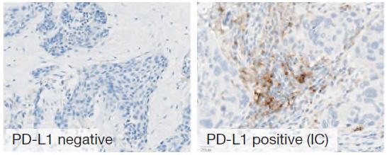 PD-L1 expression on immune cells