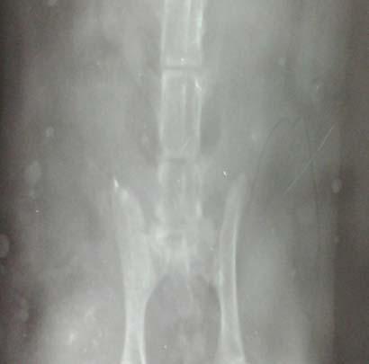 osteoarthritis of