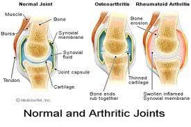 Etiology of chronic joint diseases Trauma of joint or surrounding bone/tissue Improper use, overuse, poor alignment of the joint
