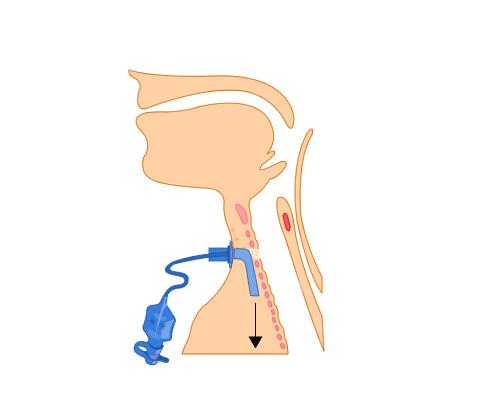 Once the trachea is entered, the tube is rotated through 90 degrees to enter the trachea.